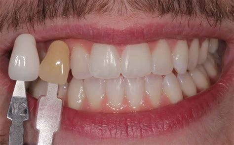 Teeth Whitening Before And After All You Need Infos