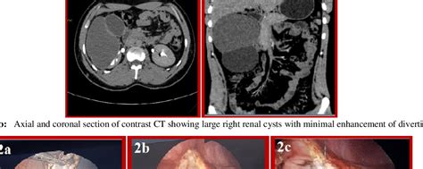 Figure 1 From Renal Calyceal Diverticulum Mimicking A Large Renal Cyst A Case Report Semantic