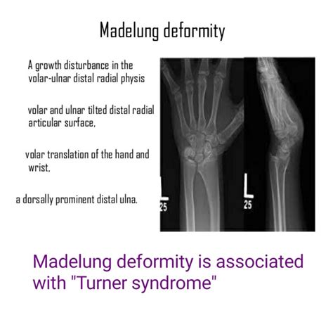 Madelung Deformity Medical Mnemonics Radiology Human Anatomy And