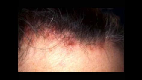 Scalp Acne Causes Scalp Acne Treatment Prevention And Help Youtube