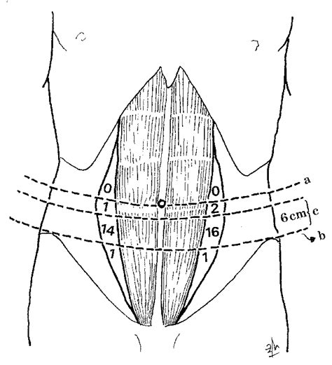 Exact Location Of 35 Spigelian Hernias On The Spigelian Aponeurosis In