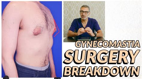 Grade Gynecomastia Surgery Breakdown Youtube