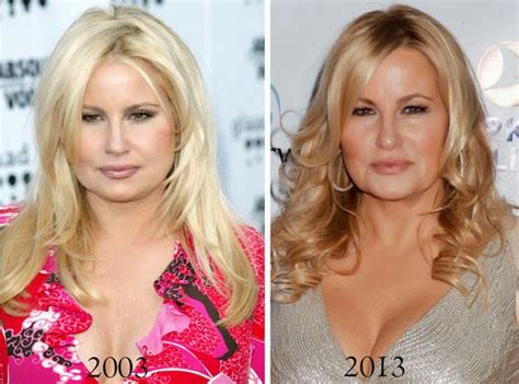 Jennifer Coolidge Plastic Surgery Botox Facial Fillers And Lips Augmentation Before And After
