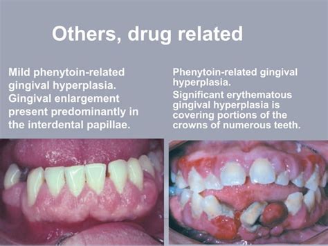 Gingival Swellings Differential Diagnosis