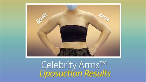 Arm Liposuction Lipo Celebrity Arms Liposuction Immediate