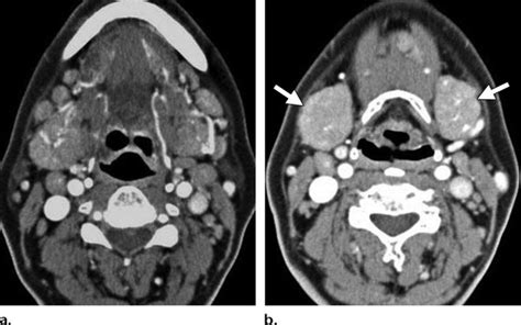 Salivary Gland Involvement In A 46 Year Old Man Contrast Enhanced Ct