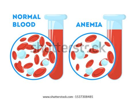 Anemia Symptoms Blood Disease Idea Health Stock Vector Royalty Free