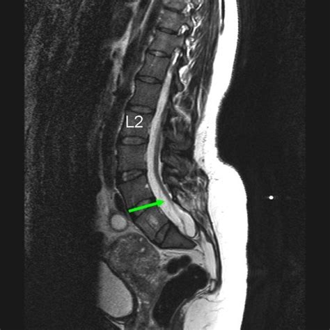 Coronal View Of Computed Tomography Scan Of The Lower Dorsal Spine