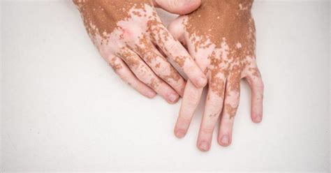 Vitiligo Conheça Os Sintomas Tratamento E Impacto Da Doença Vale Do