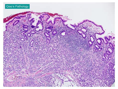 Qiao S Pathology Signet Ring Cell Adenocarcinoma Of Stomach Diffuse Type Adenocarcinoma Or
