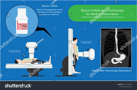 Barium Swallow Study Test Diagnose Barretts Stock Vector Royalty Free