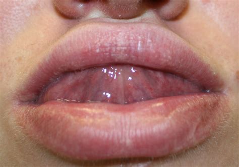 Fordyce Spots Causes Symptoms Treatment Home Remedies Pictures Healthmd