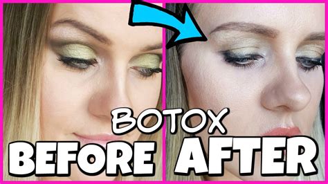 Botox Gone Wrong My Story Youtube