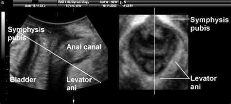 Quantification Of Major Morphological Abnormalities Of The Levator Ani