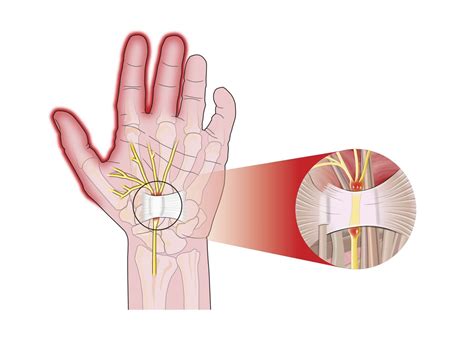 It happens because of pressure on your median nerve, which runs the length of your arm, goes through a passage in your wrist called the carpal tunnel, and ends in. Carpal Tunnel Syndrome - Premier Neurology & Wellness Center