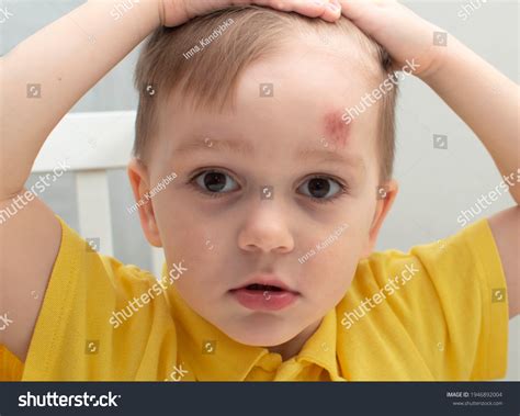 Large Bump On Babys Forehead Concept Stock Photo 1946892004 Shutterstock
