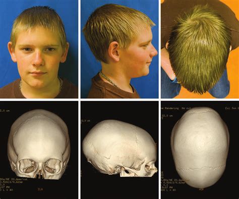 Example Of A 10 Year Old Patient With Scaphocephaly Who Opted To Forgo