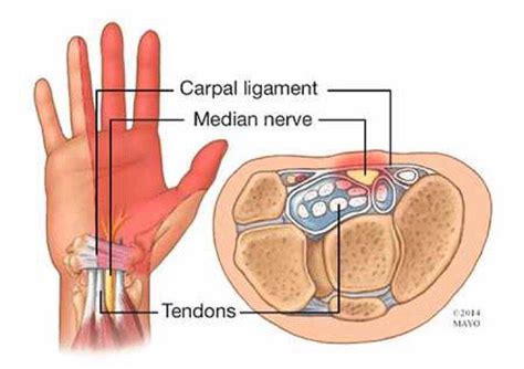 Pinched Nerve Forearm Pain The Request Could Not Be Satisfied