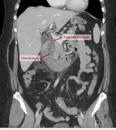 Ct Abdomen And Pelvis Showing The Common Bile Duct Cbd And Duodenal