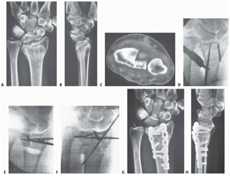 Corrective Osteotomy For Distal Radius Malunion Musculoskeletal Key