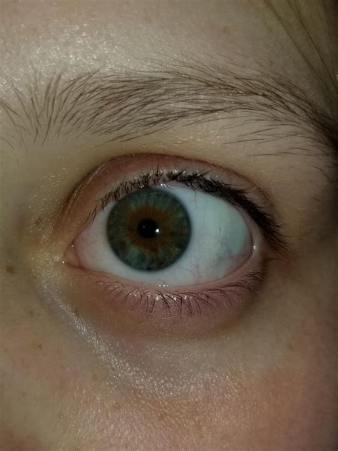 Do I Have Central Heterochromia Rheterochromia