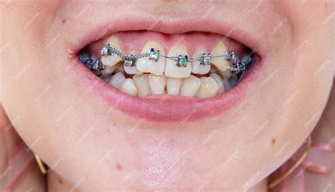 Premium Photo Braces On The Upper Jaw Are Located Close You Can See