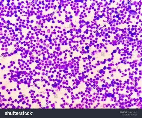 Synovial Fluid Cytology Plenty Wbc Microscopic Stock Photo 2251294247