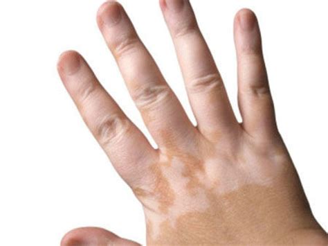12 Best Tips On How To Treat Vitiligo Kicker