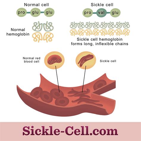 What Causes Sickle Cell Disease