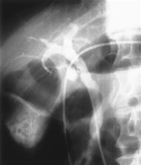 Diagnostic Pitfalls Of Mr Cholangiopancreatography In The Evaluation Of