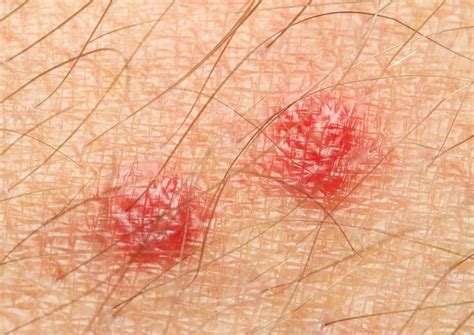 Scabies Control And Treatments For Office Building And Home