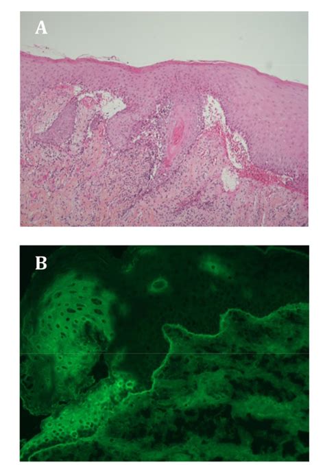 Figure 1 From Mucous Membrane Pemphigoid Bullous Pemphigoid And Anti