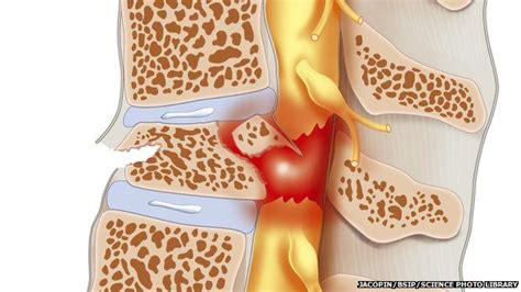 Spinal Cord Injury May Respond To Cancer Drug Bbc News