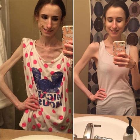 21 Fotos Do Antes E Depois De Pessoas Que Conseguiram Vencer A Anorexia