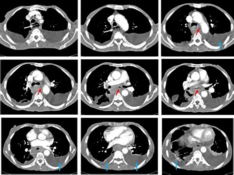 Esophageal Carcinoma Radiology Cases