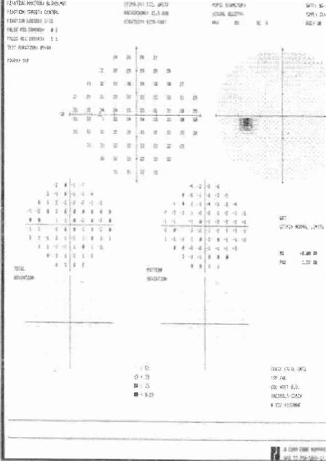 Normal Visual Field Printouts Of The Patient Download Scientific Diagram