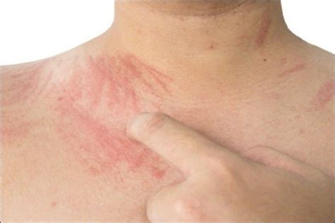 Erythema Dyschromicum Perstans Treatment In Ayurveda Dr Vikram