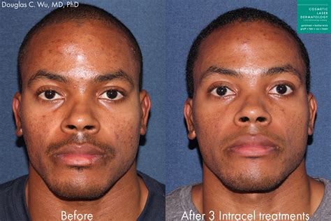 African American Skin Treatments San Diego Ca Clderm