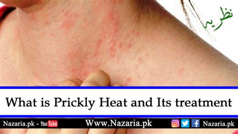 What Is Prickly Heat And Its Treatment Learn In New Research Nazariapk