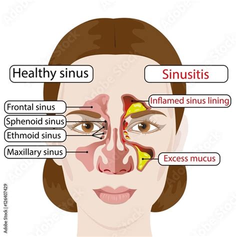Sinusitis Healthy And Inflamed Sinuses Medical Poster Stock Image