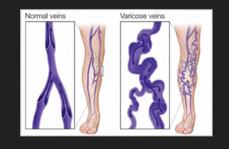 Varicose Veins Vascular Surgery Service In Delhi Nephro Star Healthcare Private Limited Id