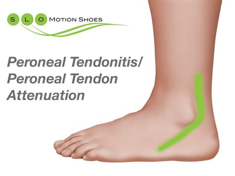 And up the outside of your lower leg when you run. Peroneal Tendon Attenuation, Peroneal Tendonitis - SLO ...