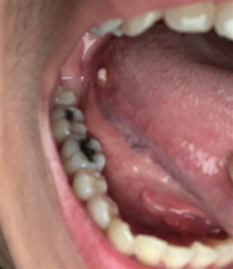 What Is This White Bump On Side Of Tongue No Symptoms Askadentist