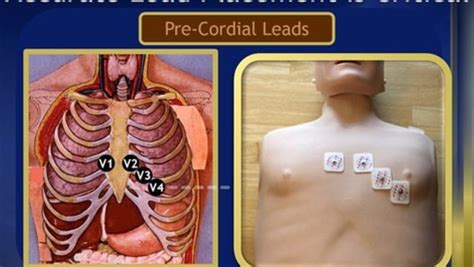 Ekg Lead Placement Video Dailymotion