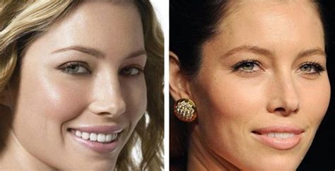 Jessica Biel Before And After Plastic Surgery 18 Celebrity Plastic