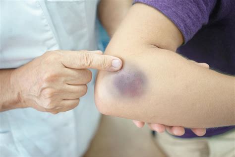 What Are Serious Bruises And How Can I Treat Them Performance Health