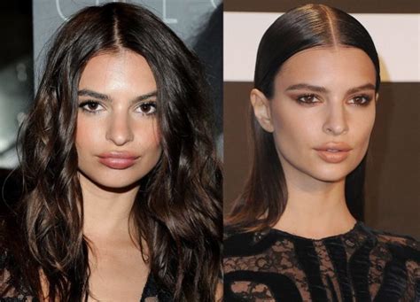 Emily Ratajkowski Before And After Plastic Surgery