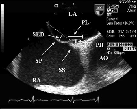 The Association Of Patent Foramen Ovale Morphology And Stroke Size In