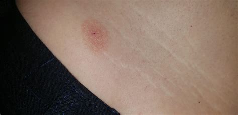 Is This A Bullseye Rash Not Sure What It Is Rlyme