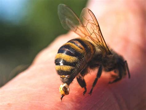 Bee Sting Allergy Symptoms Of Anaphylaxis